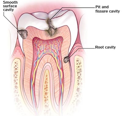 DENTIST TREATMENT OF CAVITIES