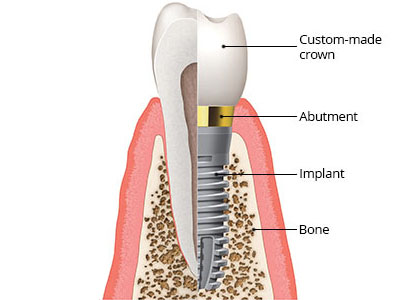 DENTIST REPLACEMENT OF MISSING TEETH